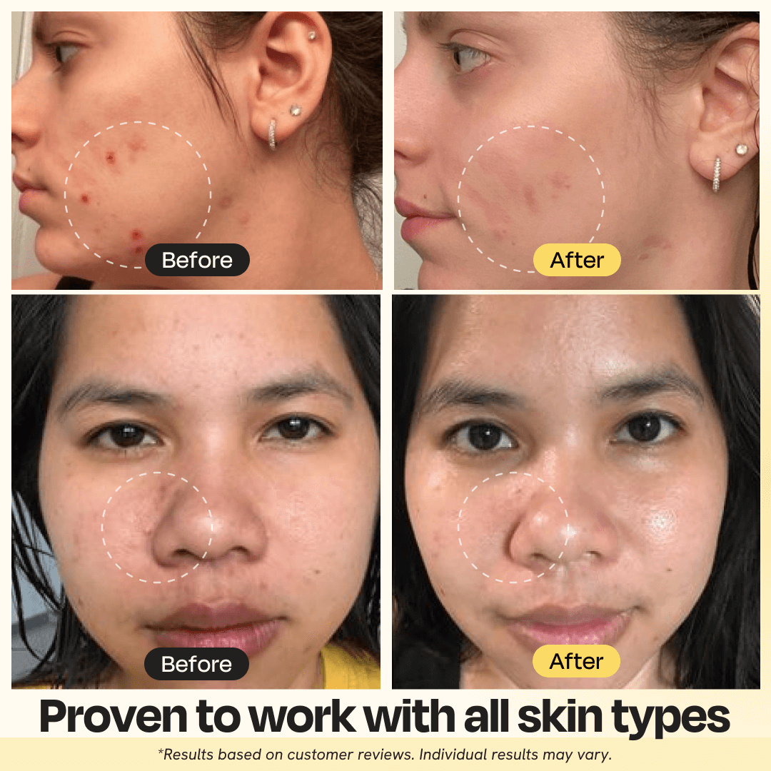 Skincare vitamin C clay mask for acne and dull skin